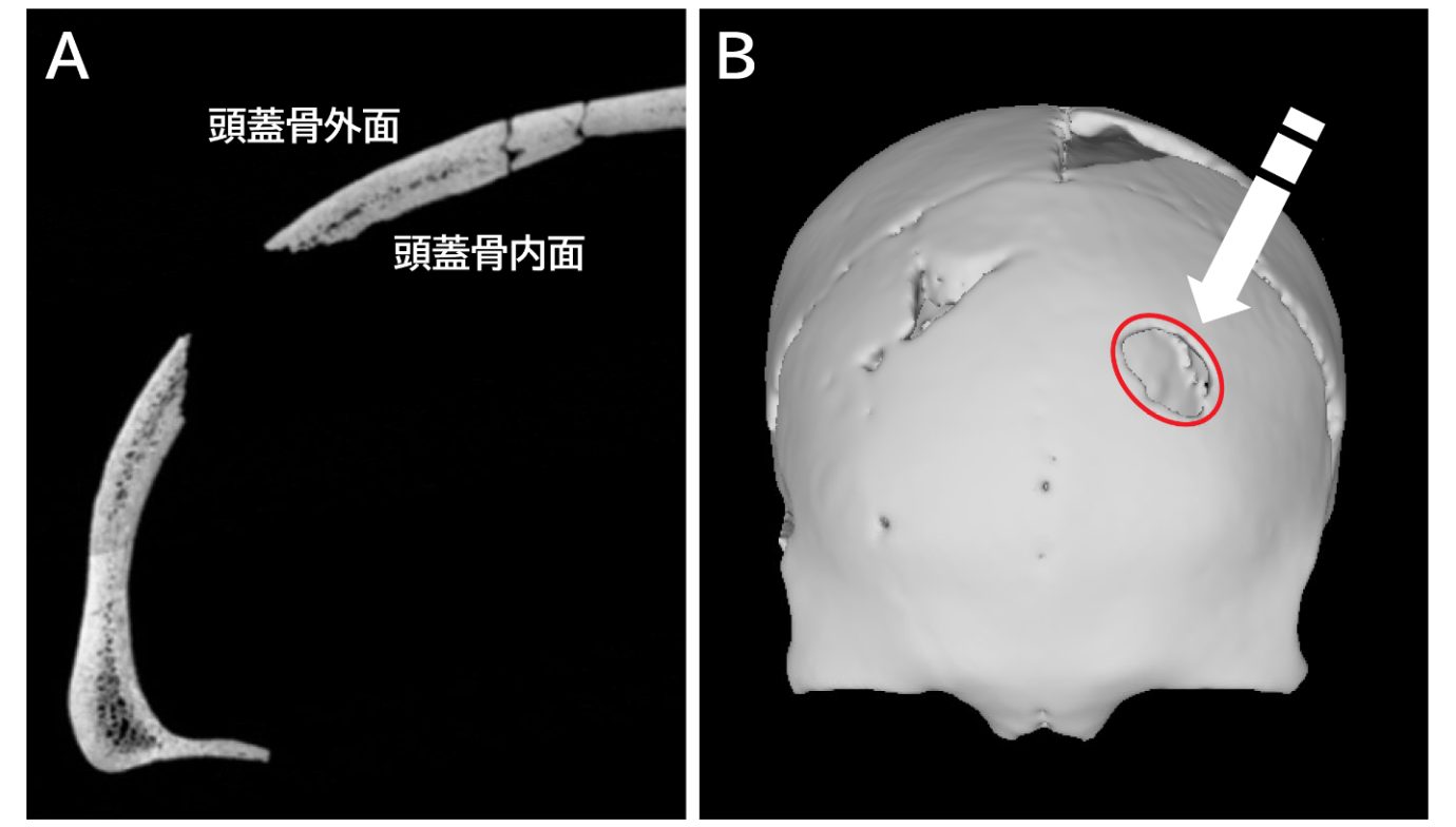 CTスキャンによるイメージ。孔は骨表面に対してほぼ垂直に、頭骨の外面から内面へ拡大している（左）。矢印の方向に刺突されたと考察される（右）。（東京大学総合研究博物館）
