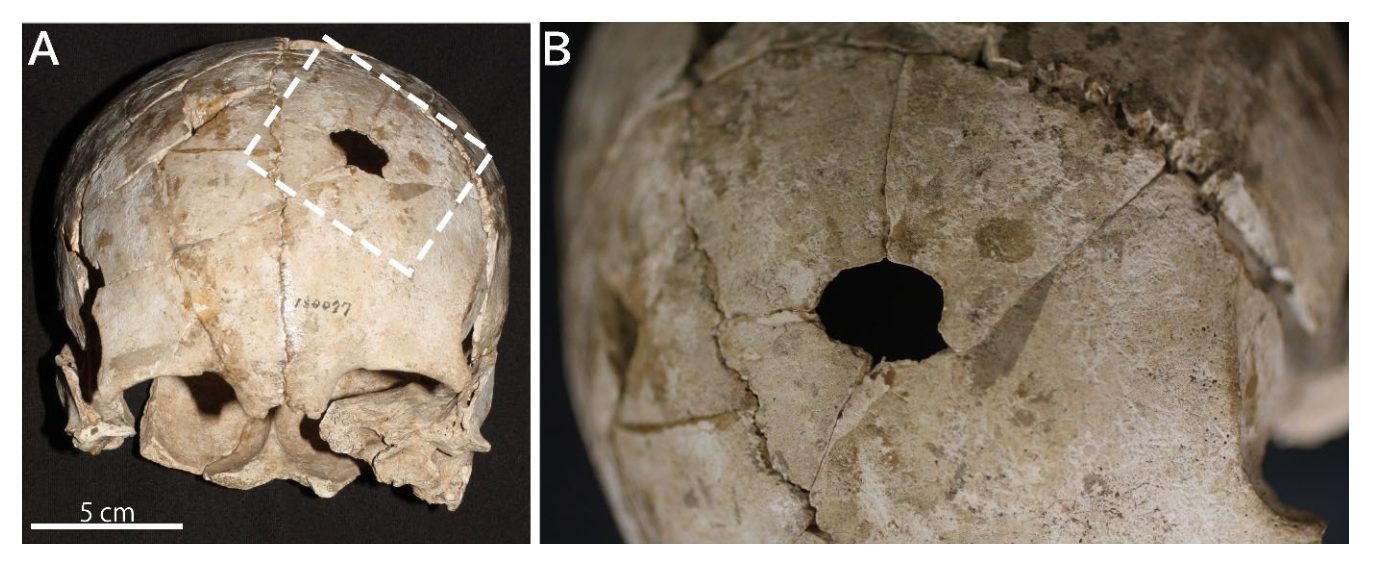 頭骨全体像（左）、左前頭部の孔（右）。（東京大学総合研究博物館）